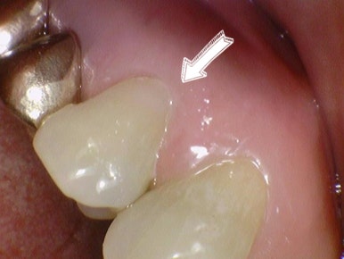 남대문치과 치아가 시리다면? 잇몸패임인가요? 관련 이미지 7