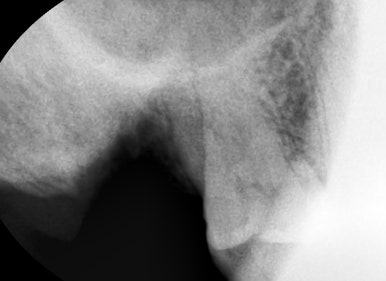 광화문 연세 예감 치과 해외에서도 찾아오는 지르코니아크라운 치료 안내해드려요 관련 이미지 14