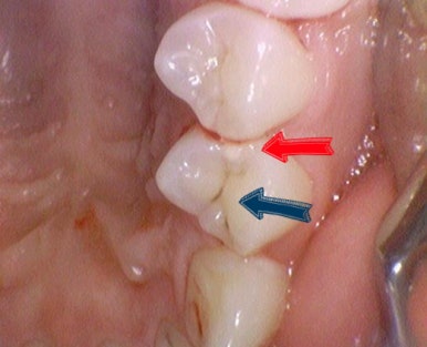 충정로 치과 인레이 해야한다고 들었는데 충치가 안보여요 관련 이미지 5