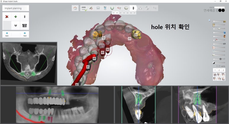 [북창동 치과/연세예감치과]내비게이션임플란트소개 관련 이미지 11