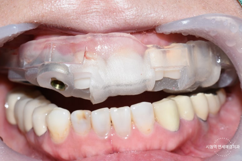 시청역 광화문  최소절개 또는 비절개로 가능한 네비게이션 임플란트 유명한 치과 내비게이션소개드려요 관련 이미지 2