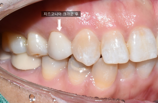[광화문/치과]어금니 금니,아말감이 보기싫다면? 이맥스 인레이 또는 지르코니아 크라운 관련 이미지 11
