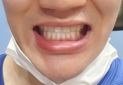 서울역 치과 투명교정 실제사례,비용가격 알아볼까요? 관련 이미지 6