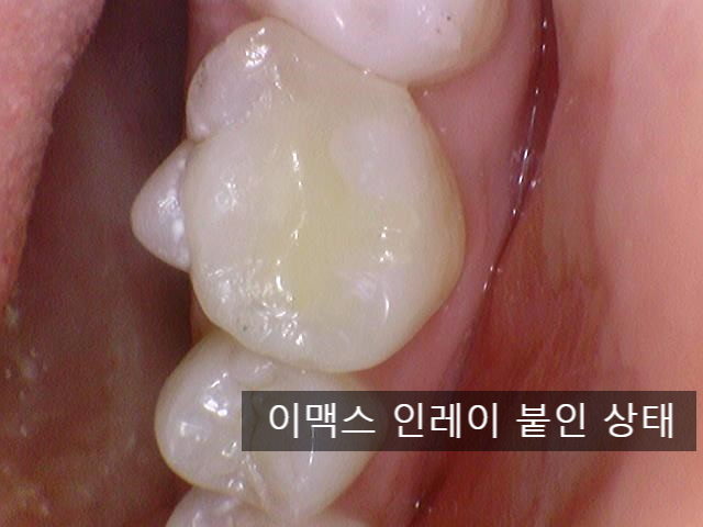 [충정로/치과] 인레이해야한다고 진단받으셨나요? 이맥스(세라믹)인레이 실제케이스 같이 살펴보아요 관련 이미지 4