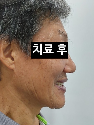 서울 중구 치과/이가 하나도 없는 환자의 치료방법/틀니, 풀아치임플란트, 전체 임플란트 등 관련 이미지 5