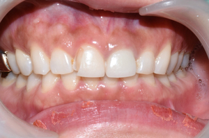 [시청역/광화문]라미네이트케이스:"치아가 작아서 옹졸해 보여요. 치아가 길어보이면 좋겠어요" 관련 이미지 7