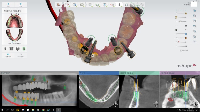 [남대문시장] 임플란트 조금 더 안아프고 간편하게 관련 이미지 16