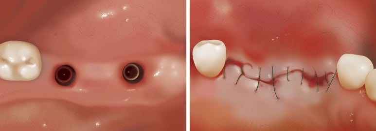 [북창동 치과/연세예감치과]내비게이션임플란트소개 관련 이미지 1