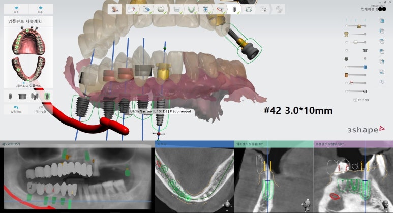시청역 광화문  최소절개 또는 비절개로 가능한 네비게이션 임플란트 유명한 치과 내비게이션소개드려요 관련 이미지 12