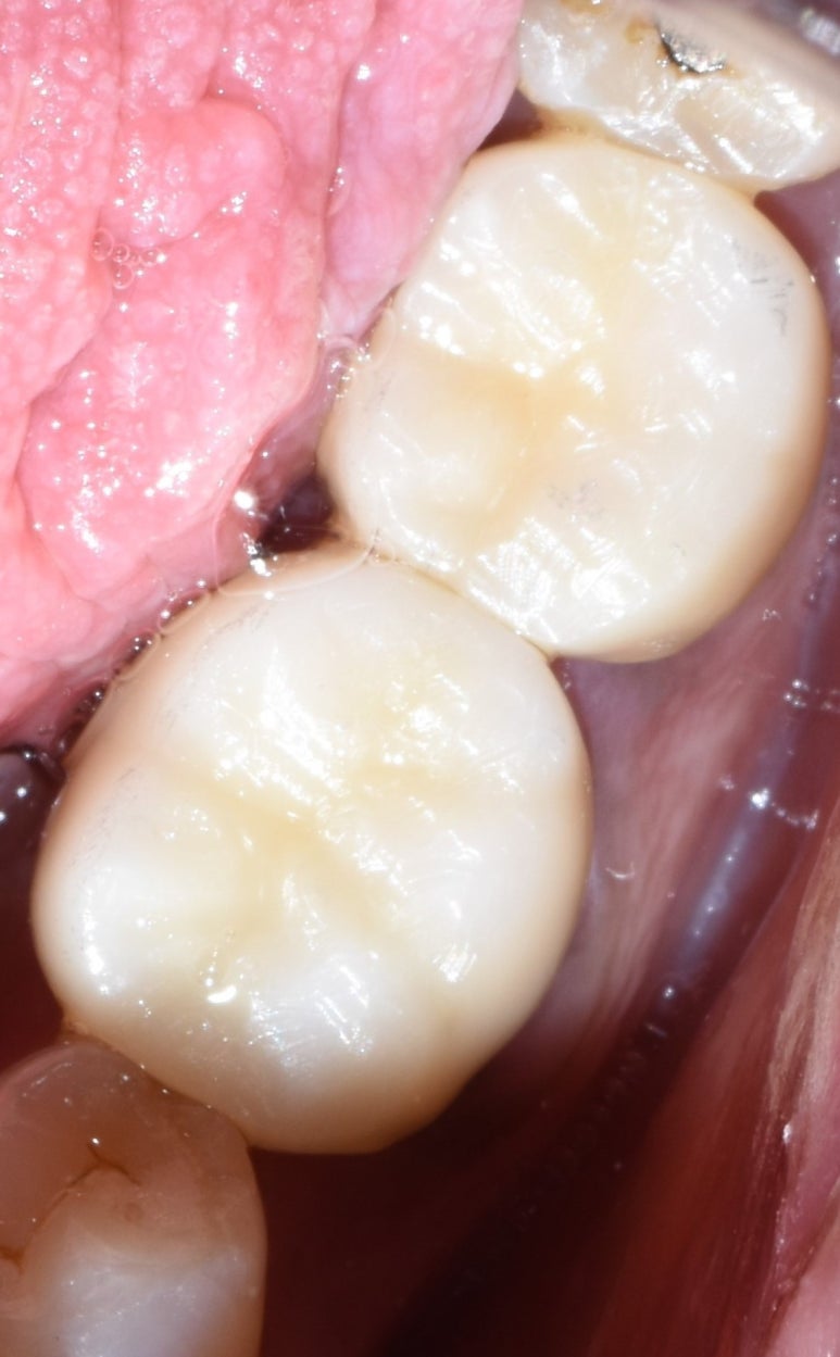 서대문역 지르코니아 크라운, 연세예감치과에서 알려드려요[실제환자사례] 관련 이미지 3