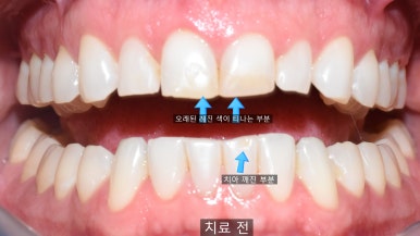 앞니 레진이 오래되어서 변색된 레진 교체 케이스 서울 시청 치과 관련 이미지 5
