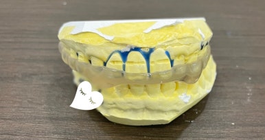 이갈이가 있다면? 이갈이 장치, 그냥 인터넷으로 사서 해도 되나요?/치과 이갈이장치 비용안내 관련 이미지 4