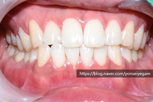 커피많이드세요? 치과에서 하는 치아미백 알려드려요[효과, 유지 등등 실제사례] 관련 이미지 4
