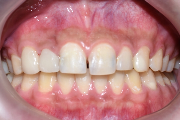 시청역치과 심한 (앞니)충치 치료방법 전후 사례 살펴보아요 관련 이미지 7