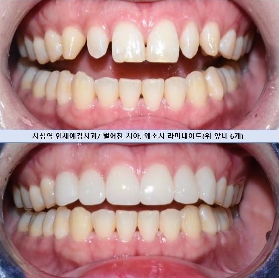 서울시청역치과/ 벌어진 앞니 치아 치료/ 왜소치, 다이아스테마 등/레진, 라미네이트, 부분교정 비교 관련 이미지 22