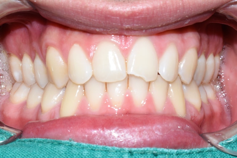 [을지로/명동 근처 치과] 앞니 레진 치료사례 관련 이미지 9