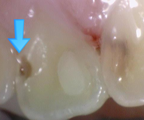 앞니충치가 너무 심해요 앞니 충치치료 방법 [시청역서울역 치과] 관련 이미지 6
