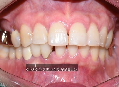 벌어진 앞니 교정치료 & 오래된 앞니 브릿지 다시하기 관련 이미지 6