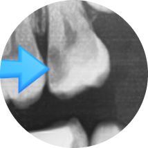 [서울시청역] 눈에 보이지 않는 충치 실제사진 관련 이미지 1
