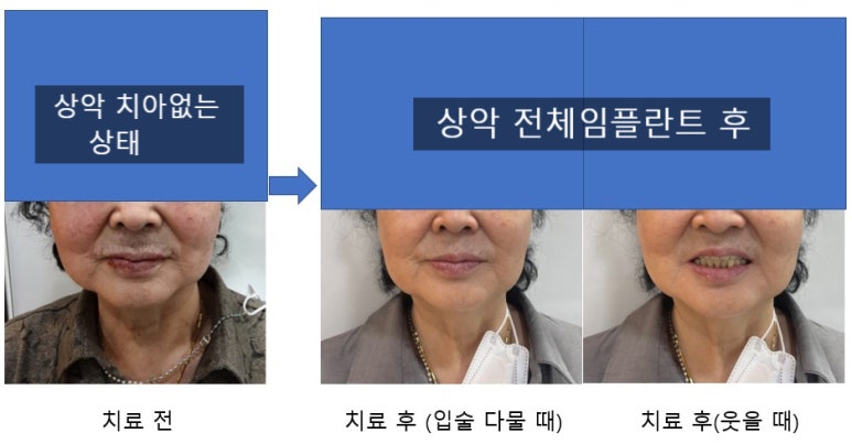 사용중인 틀니가 불편하다면? 임플란트와 틀니가 결합된 임플란트 틀니 추천 관련 이미지 9