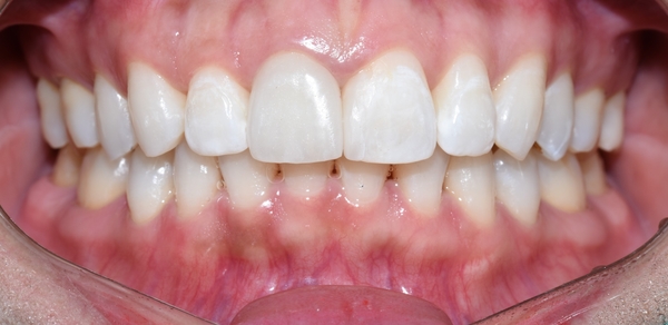 Q&A:"교정을 예전에 오래전에 했는데 앞니치아가 삐뚤어졌어요"해결방법은, 비용은? 관련 이미지 8