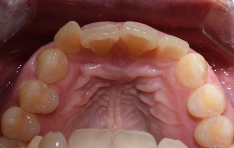 [시청역/광화문/서대문]삐뚤삐뚤한 치아 무삭제라미네이트로 치아성형 관련 이미지 3
