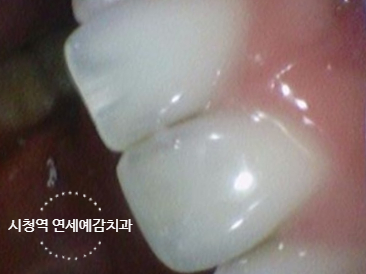 앞니 치아가 부러졌다면? 앞니부러짐 시청역 서울역 치과 치료사례 관련 이미지 8