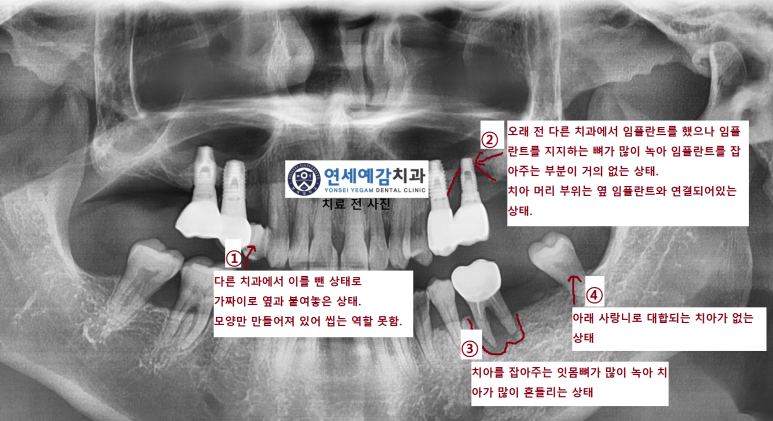 시청역 연세예감치과 임플란트여러개케이스(상악동거상+골이식+다수임플란트) 관련 이미지 3