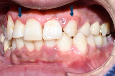 1.송곳니를 다른 앞니 모양 라미네이트로, 2.치아사이 빈공간을 라미네이트로 관련 이미지 3