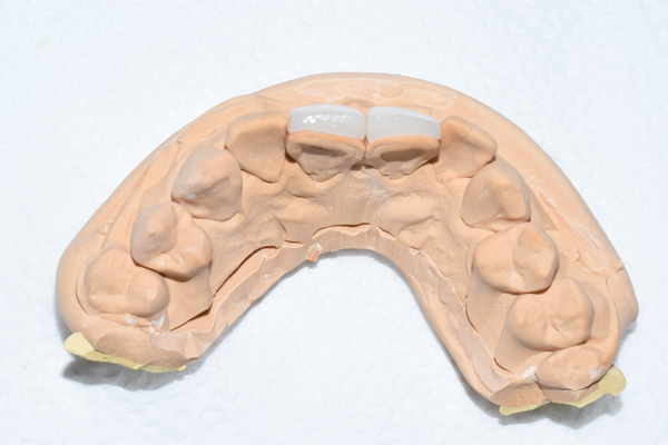 [서울시청역치과] 옥니 간단한 해결방법 찾고 계신가요? &rarr;이벤트안내 관련 이미지 8