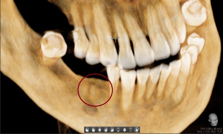 [서울역/치과] 고기 뼈를 씹고 치아가 부러졌어요 관련 이미지 6