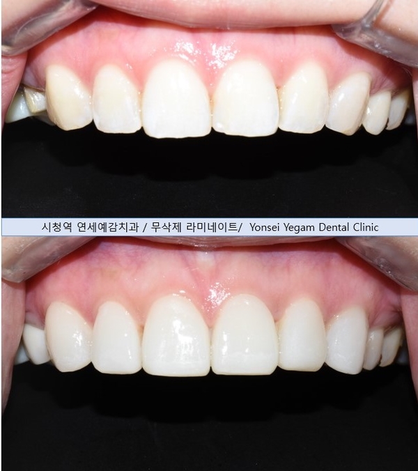 [시청역/광화문]옥니 무삭제라미네이트 전후 소개 및 이벤트 가격안내 관련 이미지 6