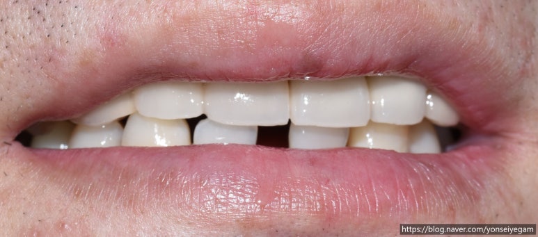 시청역치과 벌어진 앞니를 바르고 이쁘게! 대한심미학회회원치과 관련 이미지 10