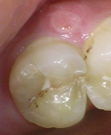 광화문 시청치과 치아가 쪼개졌어요 실제사례 관련 이미지 5