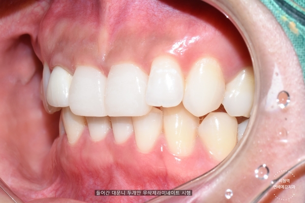 [시청역/광화문]옥니 무삭제라미네이트 전후 소개 및 이벤트 가격안내 관련 이미지 2