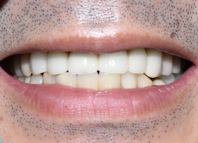 사용중인 틀니가 불편하다면? 임플란트와 틀니가 결합된 임플란트 틀니 추천 관련 이미지 5