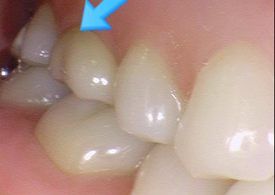 광화문/시청역"까만 아말감, 금니가 보기 싫다면?" 관련 이미지 8