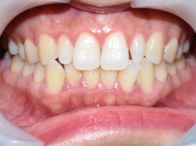 [서울/시청역] 왜소치 라미네이트 케이스 사례/비용/알려드려요 관련 이미지 2