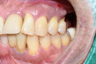 오래된 임플란트가 흔들려요 인플란트 재수술도 서울역가까운치과 연세예감치과 관련 이미지 10