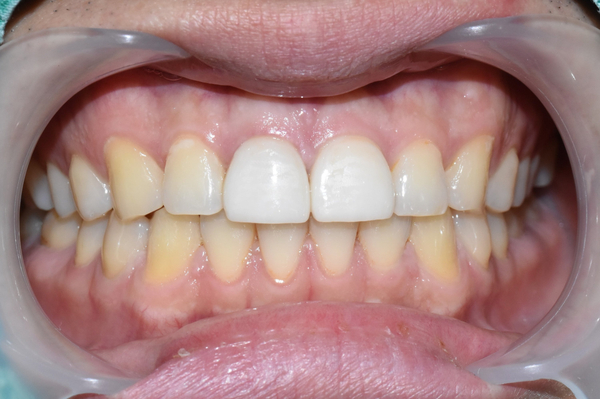 앞니깨짐 실제 치료 사례, 넘어져서 변색된 앞니 깨진 앞니 관련 이미지 8