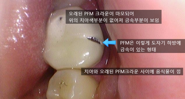 해외에서도 믿고 찾아오는 서울 시청역 치과 연세예감치과에서 소개하는 지르코니아 크라운 관련 이미지 11