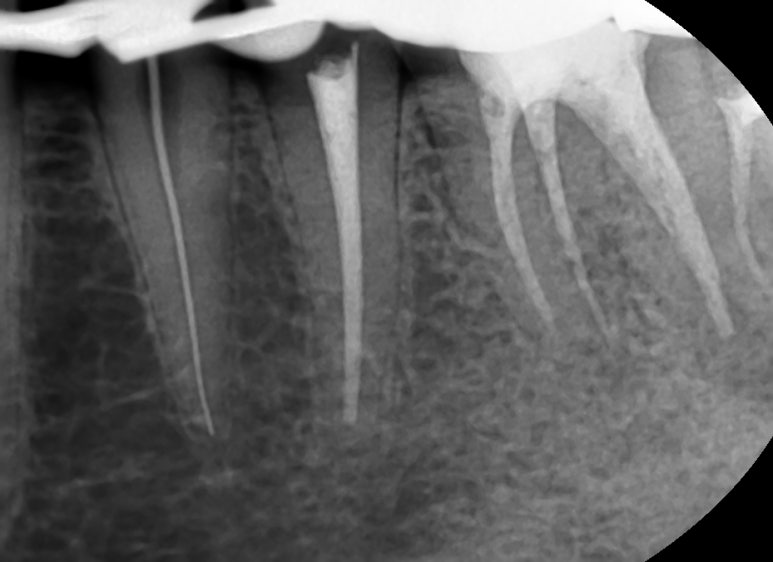 Q&A)충치, 꼭 치료해야 하나요?? 관련 이미지 4