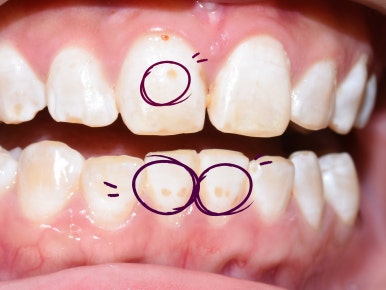 서울시청역 앞니 치아에 갈색 점, 흰색점 치료 전후 관련 이미지 4