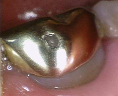 광화문/시청역"까만 아말감, 금니가 보기 싫다면?" 관련 이미지 4