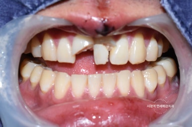 넘어져서 또는 부딪혀서 앞니 아주 많이 부러진 경우, 시청역치과 실제 앞니브릿지케이스 관련 이미지 1