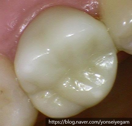 시청역치과 [Q&A]다른치과에서 한 인레이,크라운,임플란트에 음식물이 껴요 관련 이미지 6