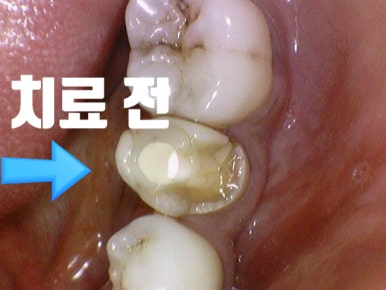 금크라운을 치아색 지르코니아 교체? 또는 크라운이 빠져서 새크라운?  광화문 시청역 서울역 치과, 가격까지! 관련 이미지 5