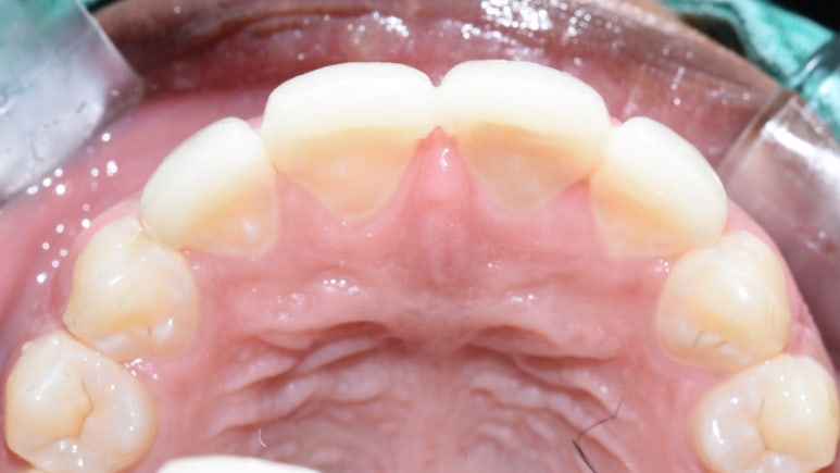 명동 가까운 치과 /외국인 흑인분의 매우 벌어진 앞니 치료 (빠른 부분교정(3개월)+라미네이트)/가격안내 관련 이미지 6