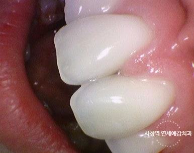 서울시청역 앞니 치아에 갈색 점, 흰색점 치료 전후 관련 이미지 11