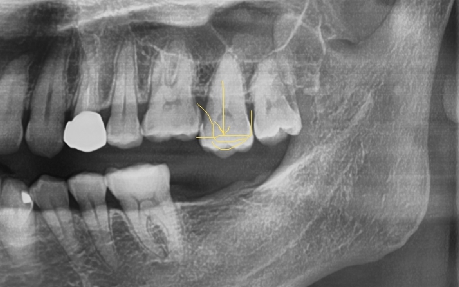 [서울시청역치과] 20대, 30대도 임플란트를 하나요?? +네비게이션임플란트안내 관련 이미지 2